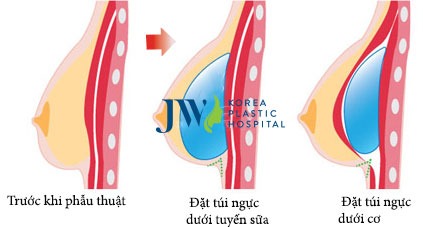 Nâng ngực túi Nano