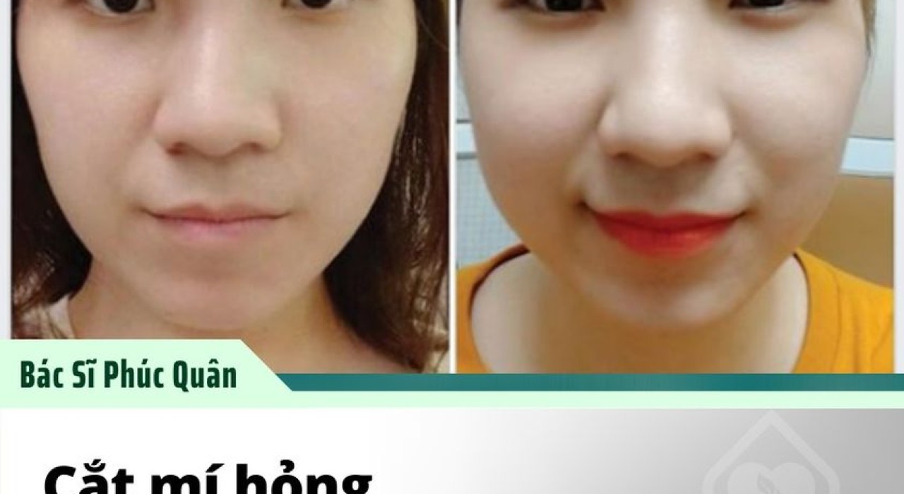 Những Trường Hợp Cắt Mí Hỏng - Nguyên Nhân Và Cách Khắc Phục