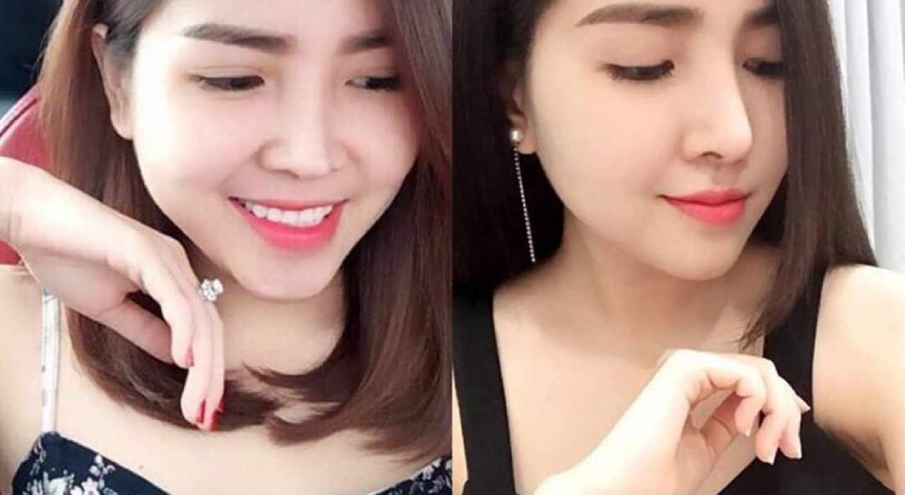 Nâng mũi cấu trúc và nâng mũi bọc sụn khác nhau như thế nào?