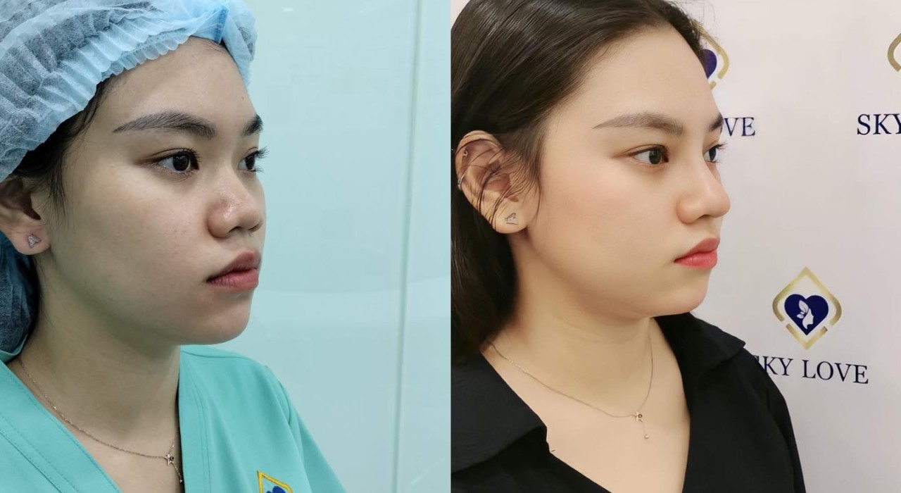 Nâng mũi bọc sụn Mỹ - Giải pháp cho người đầu mũi to