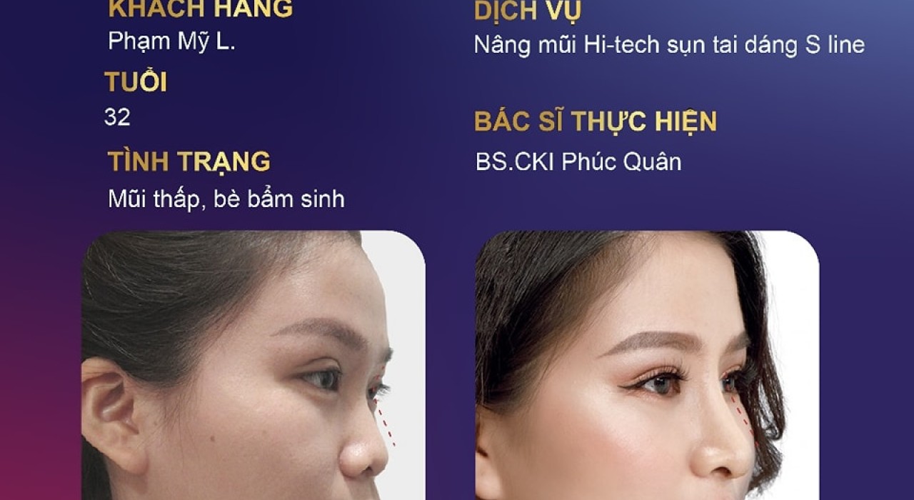 Tại sao sau khi nâng mũi bị rỉ dịch? – Làm sao để khắc phục