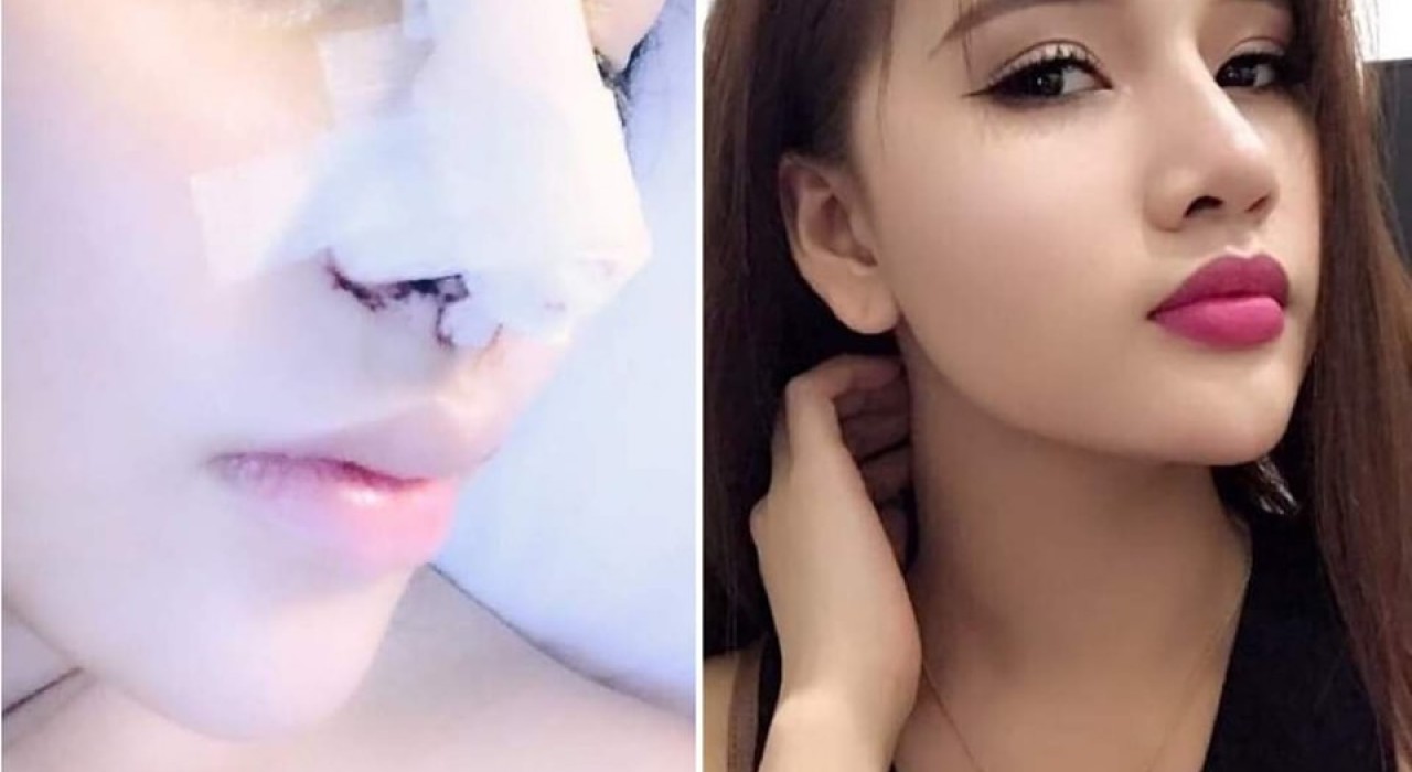 Hậu phẫu thuật mũi bị dài quá – Phải làm sao?
