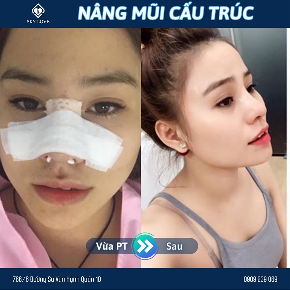 Nguyên Nhân Và Cách Khắc Phục Khi Phẫu Thuật Xong Mũi Bị Thấp