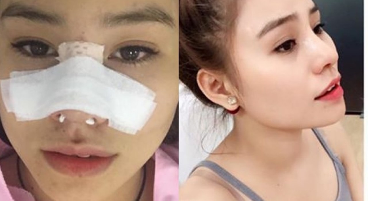 Nguyên Nhân Và Cách Khắc Phục Khi Phẫu Thuật Xong Mũi Bị Thấp