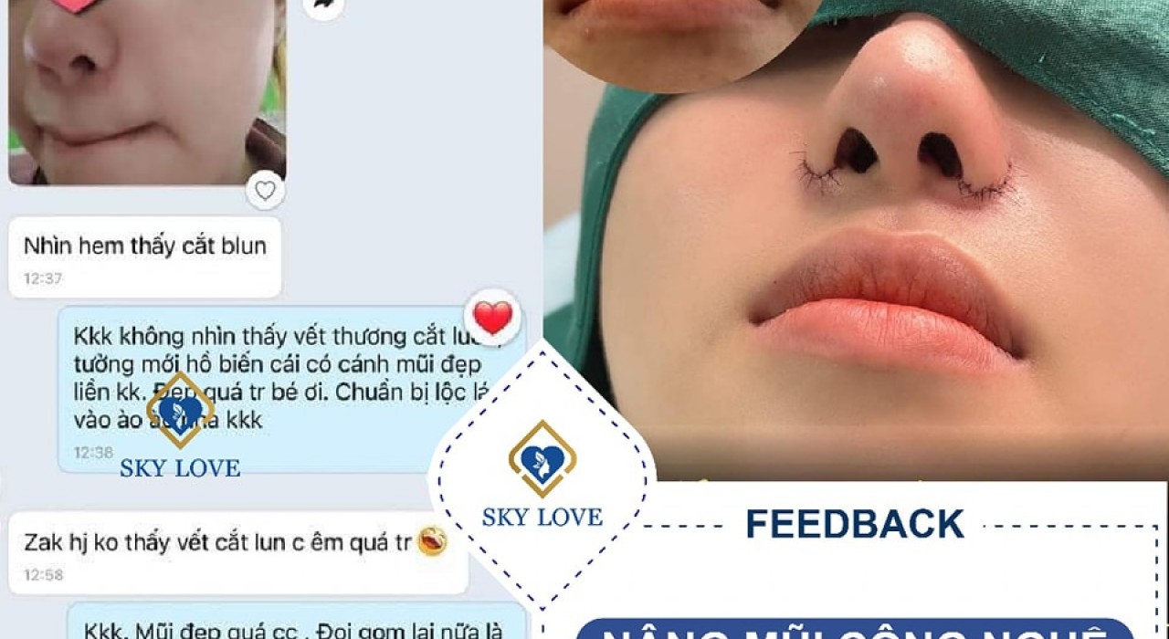 Phẫu thuật nâng mũi bị cắt sót chỉ thì có nguy hiểm không ?
