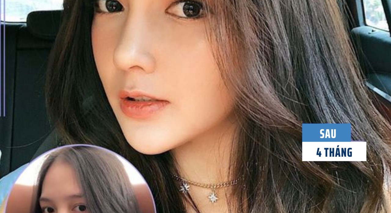 Mũi Thế Nào Thì Hài Hoà Với Mặt? Nâng Mũi Có Thay Đổi Khuôn Mặt Không?