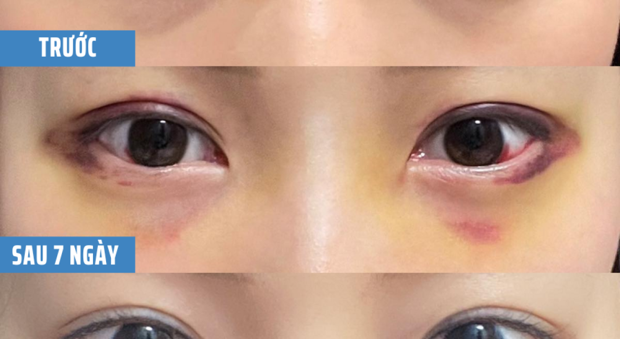 PHẪU THUẬT CẮT MÍ MẮT CÓ BIẾN CHỨNG KHÔNG ?