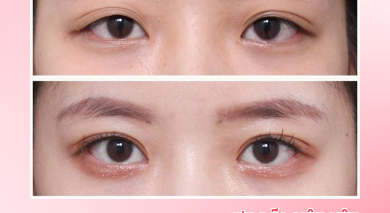 BÍ QUYẾT CHO ĐÔI MẮT ĐẸP, NHANH LÀNH SAU KHI CẮT MÍ