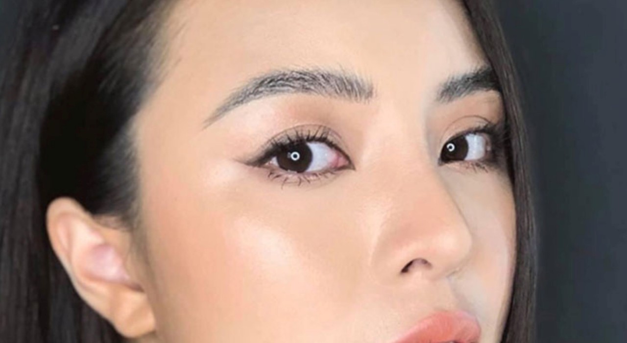 Nên nâng mũi bằng chỉ hay tiêm filler?