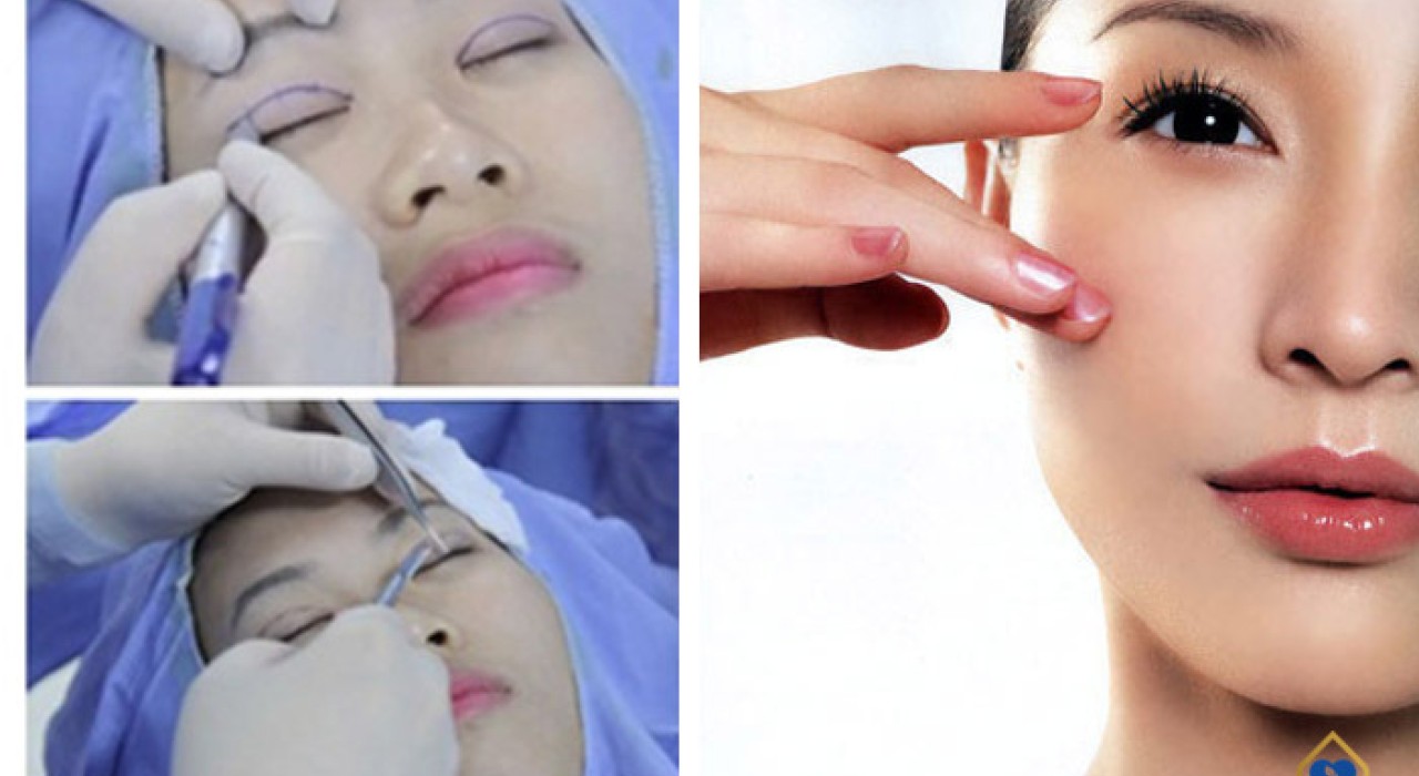 Cắt Mí Mắt Có Nguy Hiểm Không? Những Khuyến Cáo Khi Thẩm Mỹ
