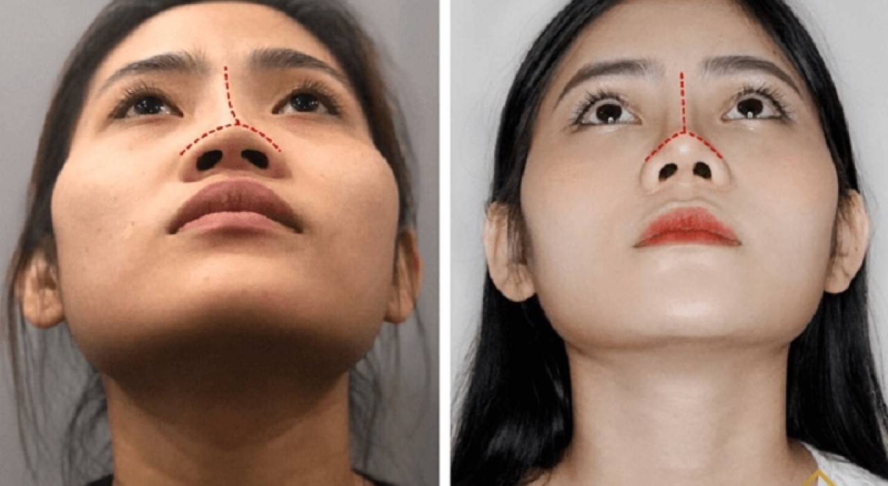 CÓ NÊN ĐI CẮT CÁNH MŨI KHÔNG? NHỮNG LƯU Ý QUAN TRỌNG