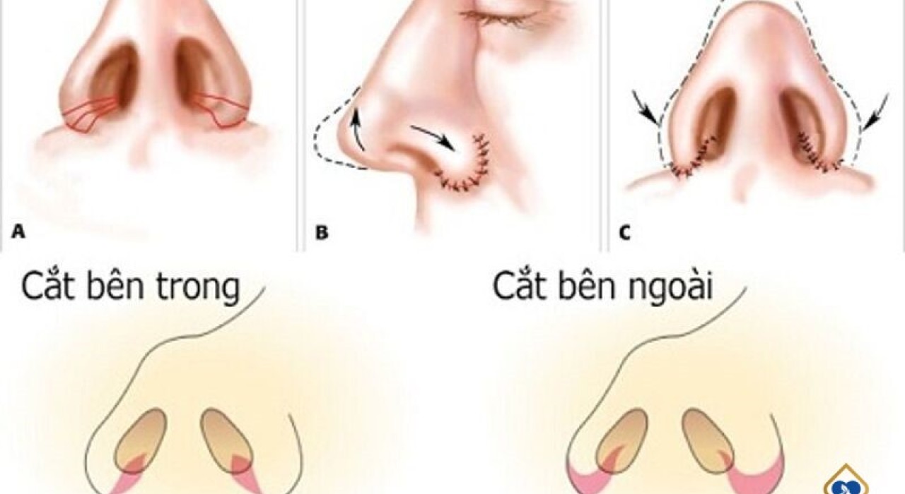 Cuộn cánh mũi là gì? Làm sao phân biệt giữa cuộn cánh mũi và cắt cánh mũi