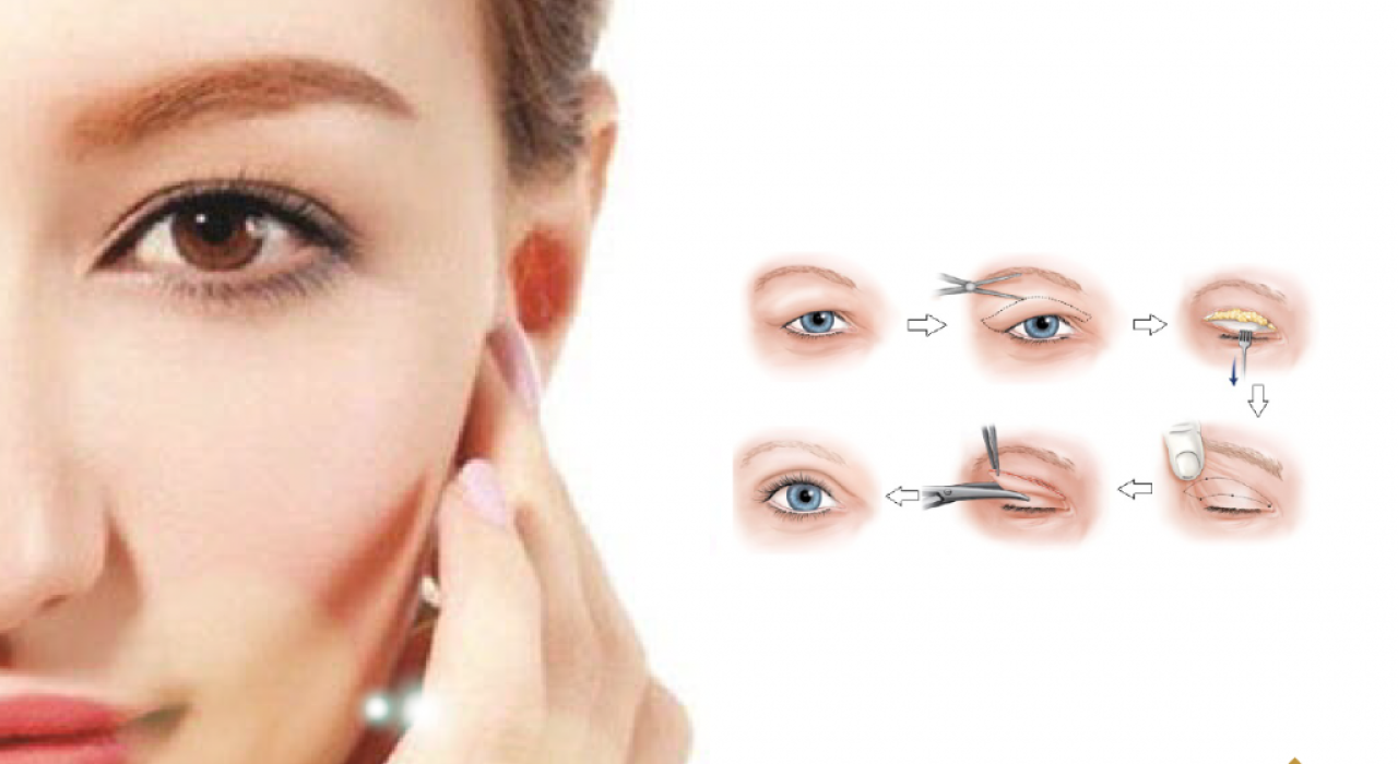 Cắt da thừa mí mắt là gì? Có tác dụng gì?