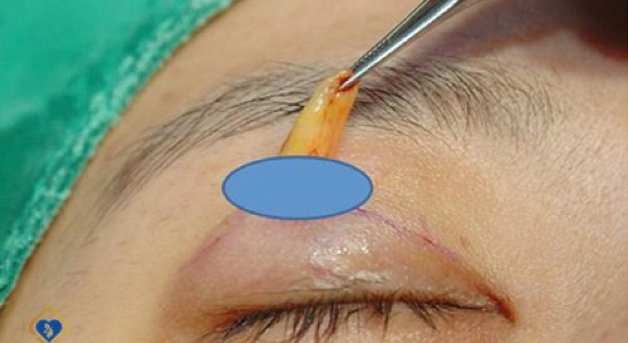 Lấy mỡ mí trên – Giải pháp chấm dứt sụp mí triệt để