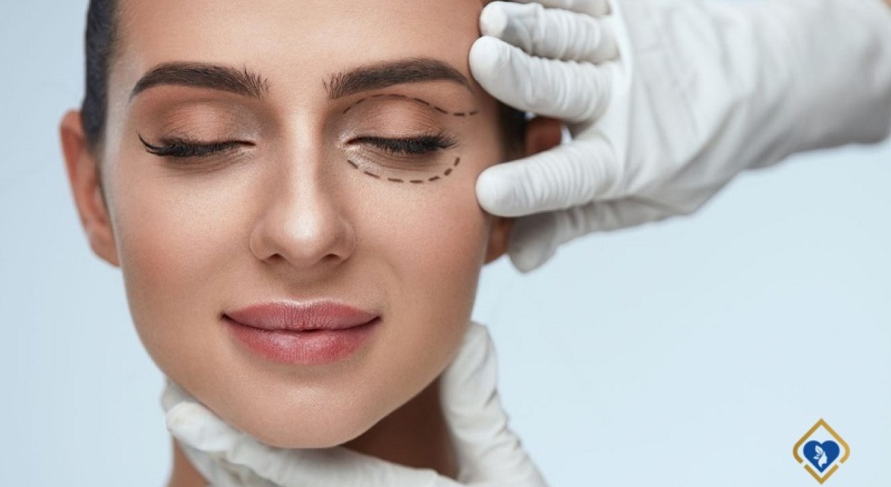 Lấy mỡ bọng mắt (Cắt bọng mắt) có để lại sẹo không? Cần lưu ý những gì