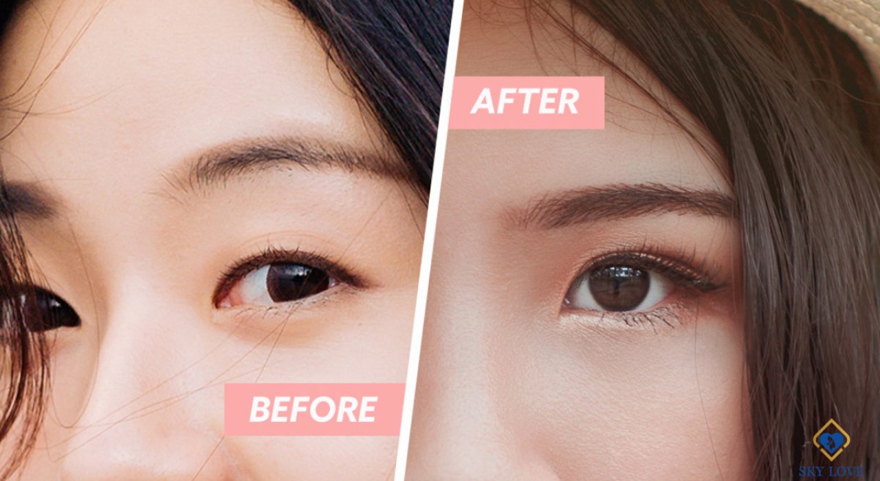 Nhấn mí luồn chỉ là gì? phù hợp với những ai?