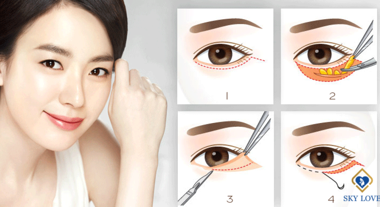 Lấy Mỡ Mí Mắt – Bí Quyết Cho Mắt Đẹp Tinh Anh