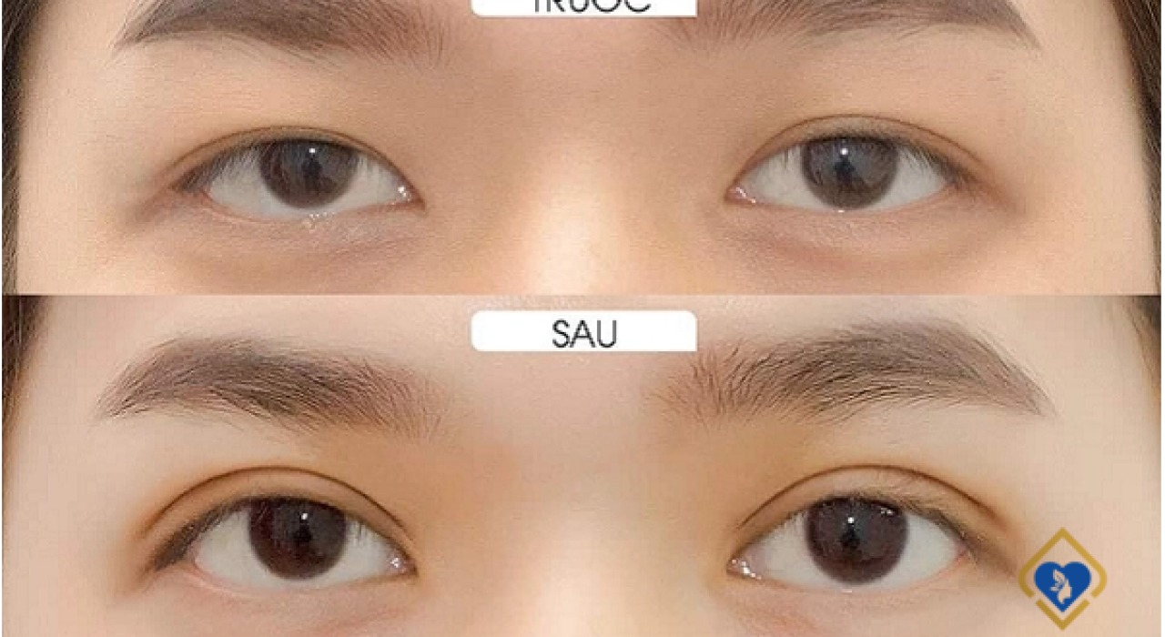 Cắt Mắt Hai Mí Và Những Ngộ Nhận Không Phải Ai Cũng Biết