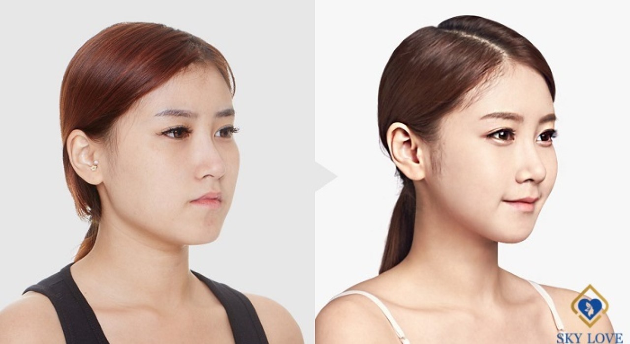 Tái Phẫu Thuật Mũi – Giải Pháp Khắc Phục Mọi Dáng Mũi Biến Chứng