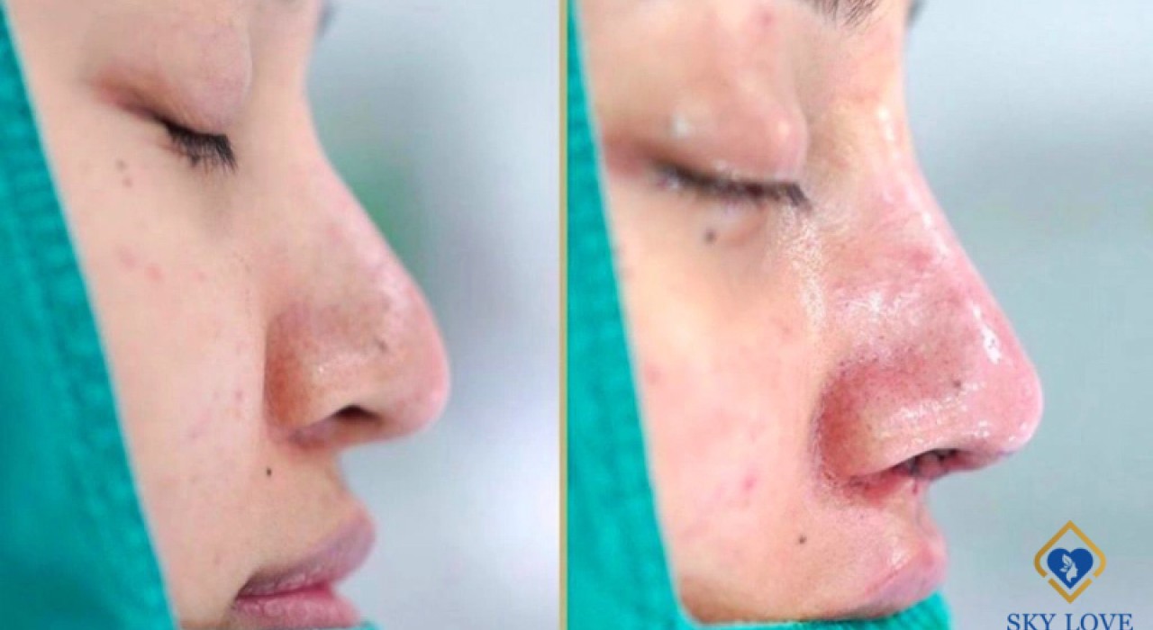 Tụ Dịch Sau Nâng Mũi Là Gì? Kiểm Tra Mức Độ Bất Thường