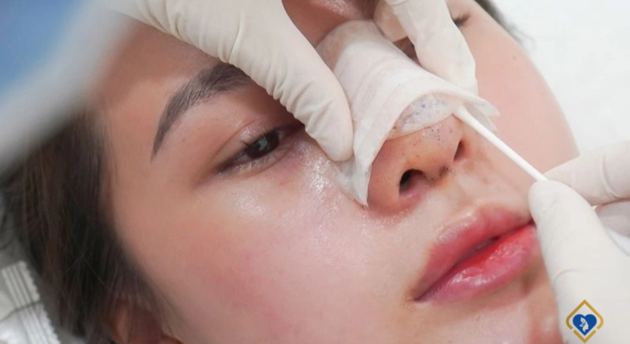 Nguyên Nhân Và Cách Xử Lý: Nâng Mũi 7 Ngày Mà Vẫn Còn Sưng