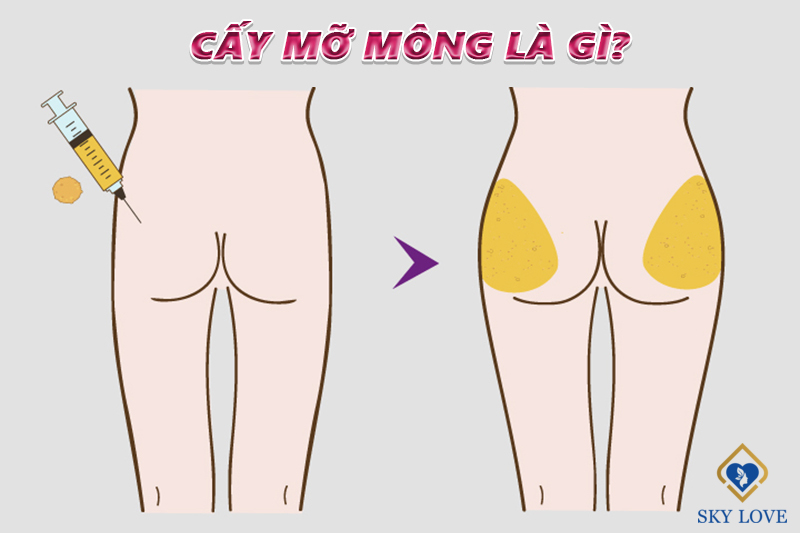 Cấy mỡ mông là gì? Có nên cấy mỡ mông không?