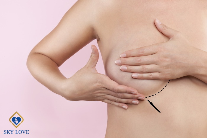 Phẫu Thuật Nâng Ngực – Giải Cứu “Ngực Mướp”