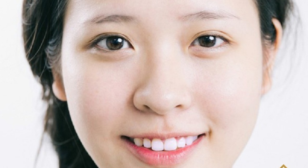 Mũi Lân, Mũi Sư Tử Là Gì? Có Nên Sửa Hay Không? Nên Sửa Ở Đâu?