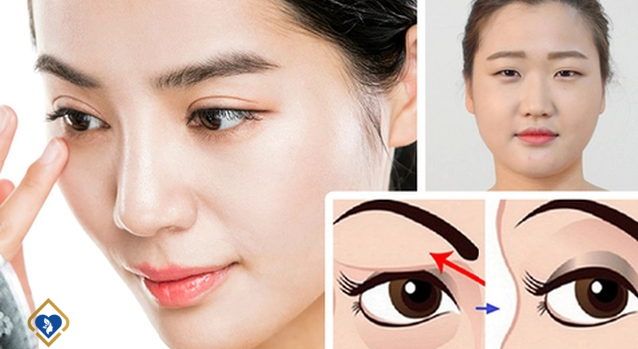 Có nên cắt mắt 2 mí không? Những điều bạn chưa biết