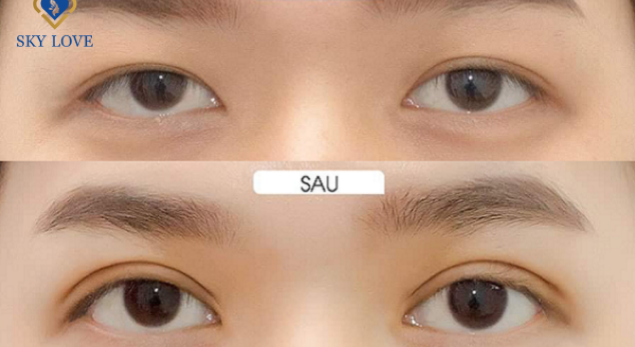 Cắt mí mắt Nam có gì khác so với Nữ giới?