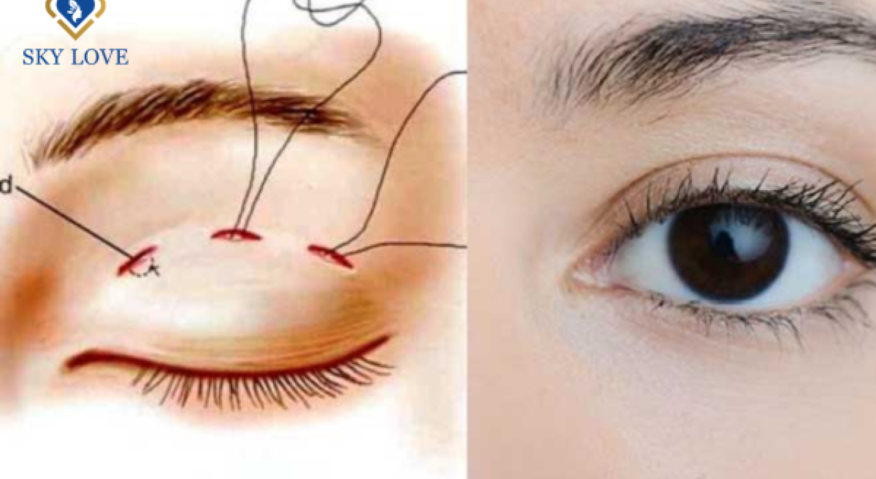Nhấn mí bằng chỉ: Bí quyết tạo nên đôi mắt quyến rũ