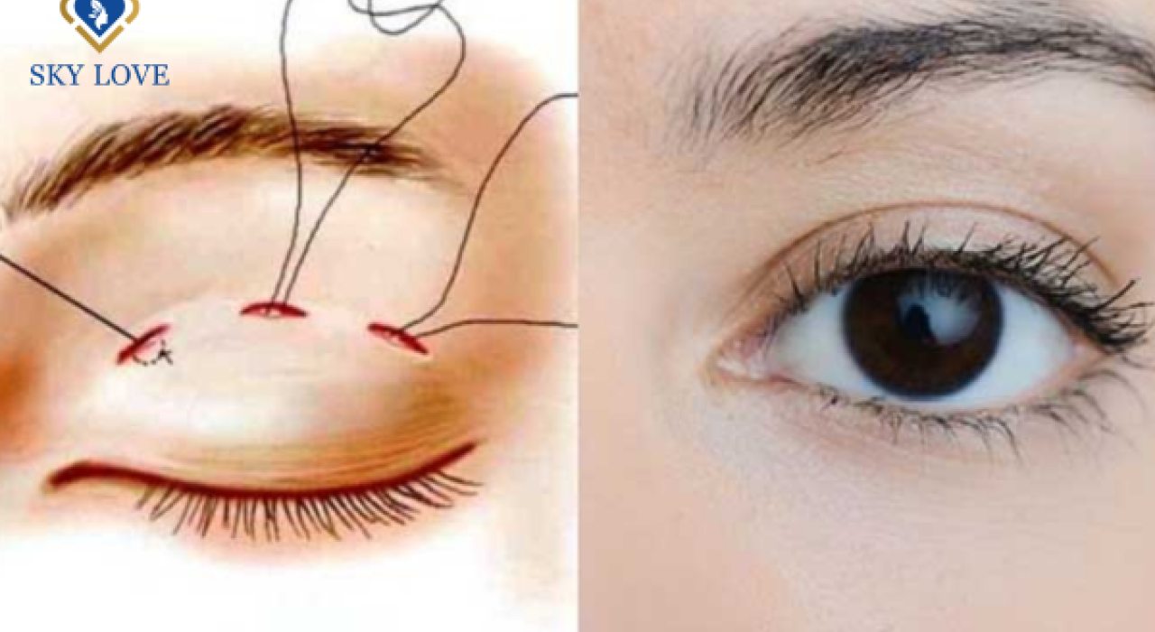 Nhấn mí có để lại sẹo không: cách chăm sóc đúng cách