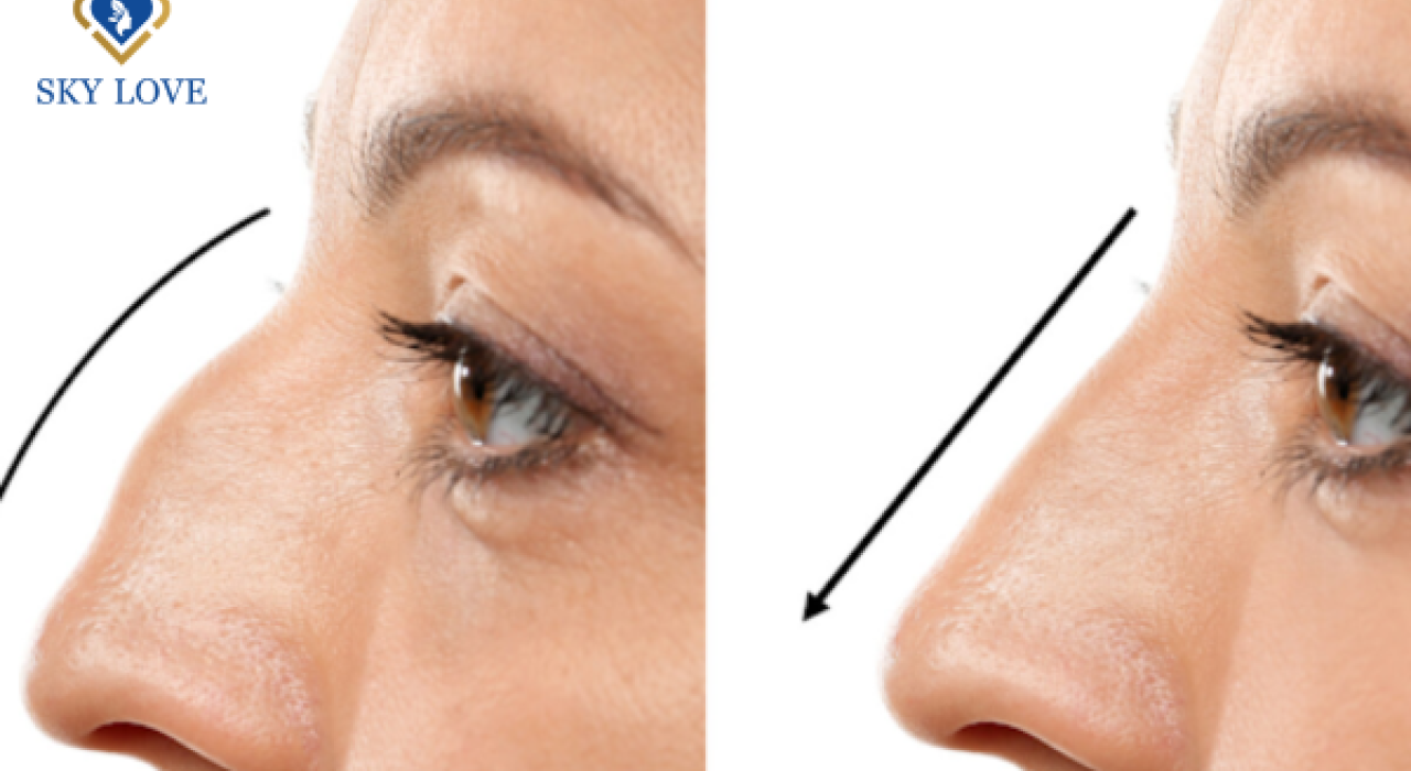 Mũi gồ làm sao để khắc phục – Bác sĩ Phúc Quân giải đáp