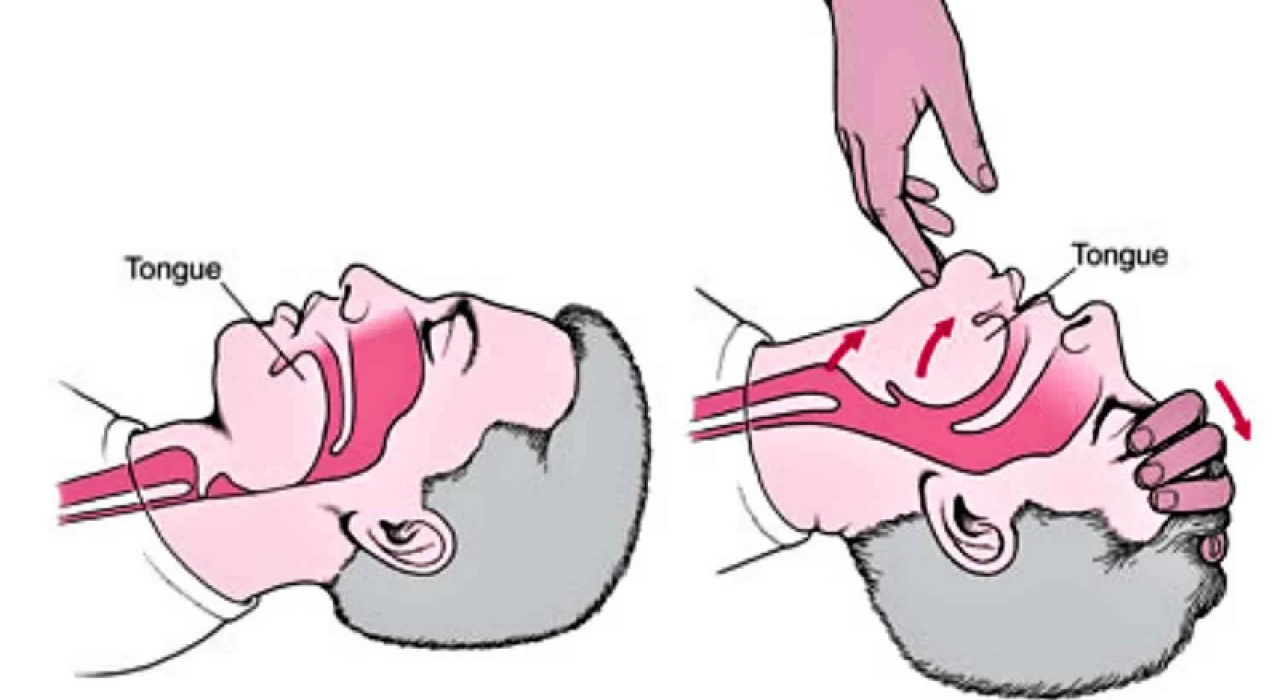 ĐẶT CANUYN MŨI HẦU, MIỆNG HẦU