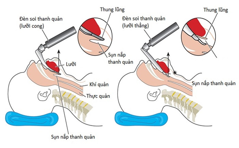 ĐẶT NỘI KHÍ QUẢN