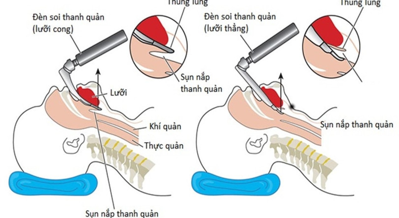 ĐẶT NỘI KHÍ QUẢN