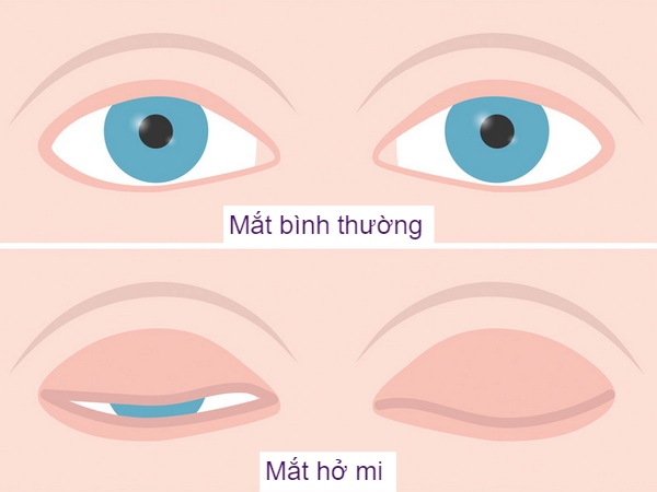 PHẪU THUẬT ĐIỀU TRỊ HỞ MI