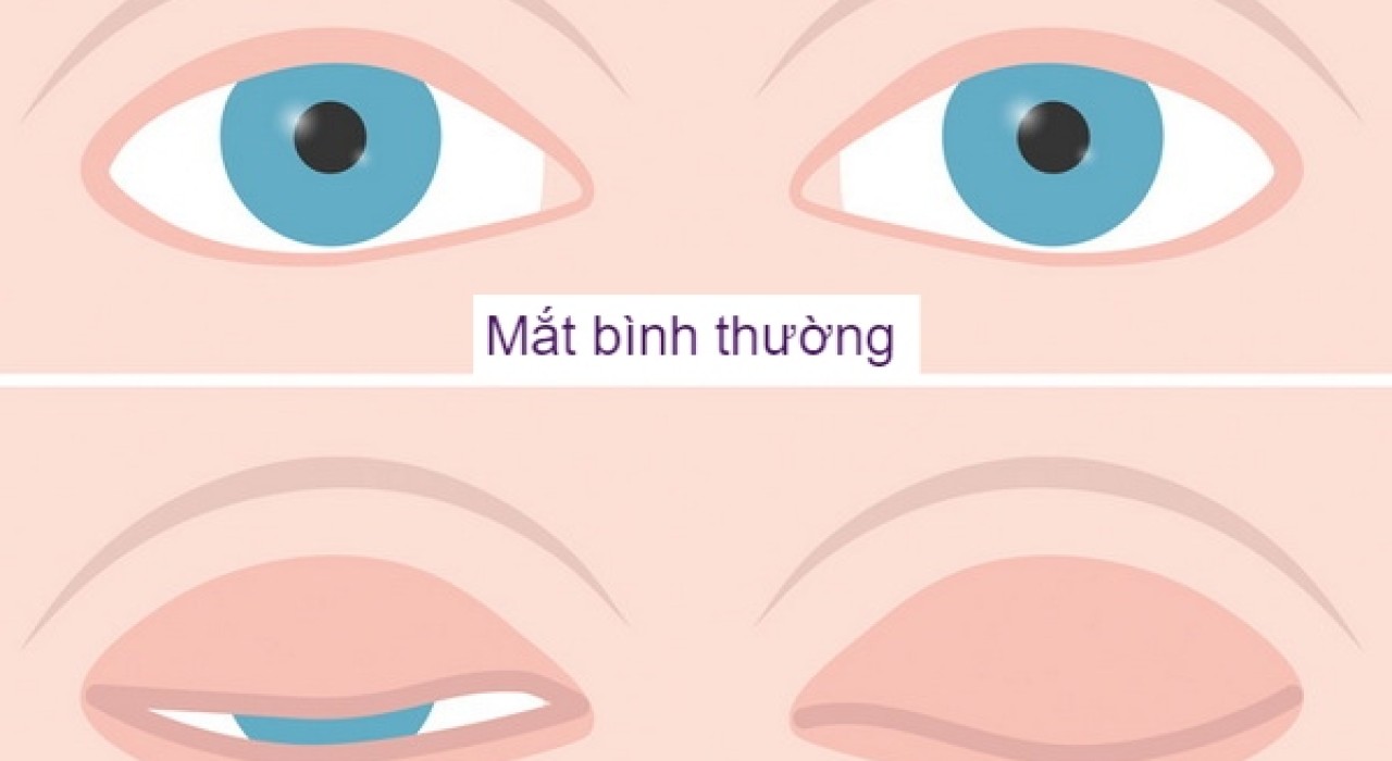 PHẪU THUẬT ĐIỀU TRỊ HỞ MI