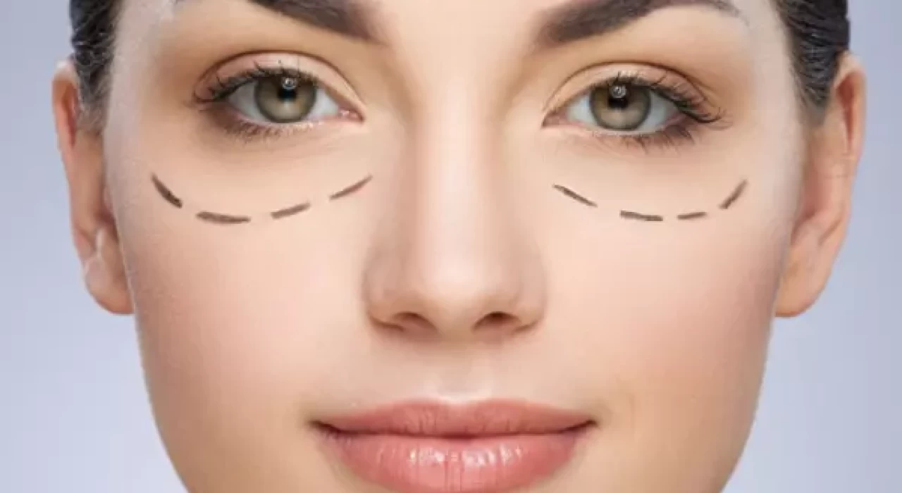 PHẪU THUẬT KHÂU CƠ KÉO MI DƯỚI ĐỂ ĐIỀU TRỊ LẬT MI DƯỚI