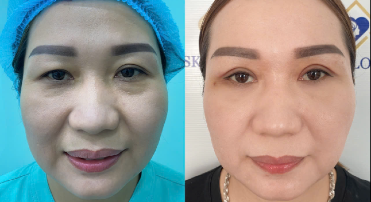 PHẪU THUẬT ĐIỀU TRỊ TRỄ MI DƯỚI