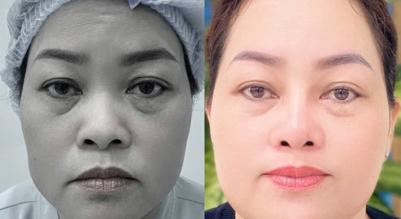 PHẪU THUẬT TẠO HÌNH CÁNH MŨI BẰNG GHÉP PHỨC HỢP VÀNH TAI