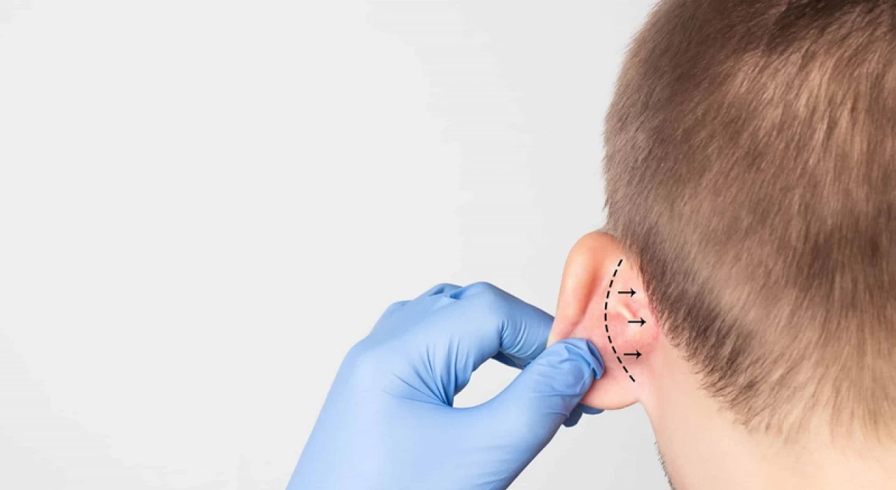 PHẪU THUẬT TẠO HÌNH SẸO LỒI QUÁ PHÁT VÀNH TAI