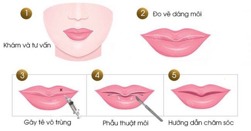 PHẪU THUẬT THU GỌN MÔI DÀY