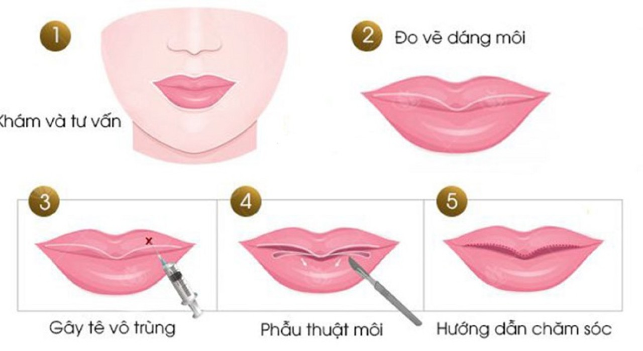 PHẪU THUẬT THU GỌN MÔI DÀY