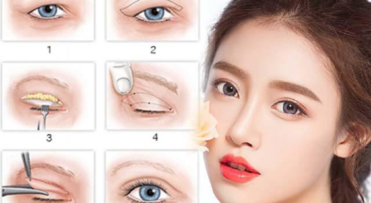 PHẪU THUẬT TẠO HÌNH MẮT HAI MÍ