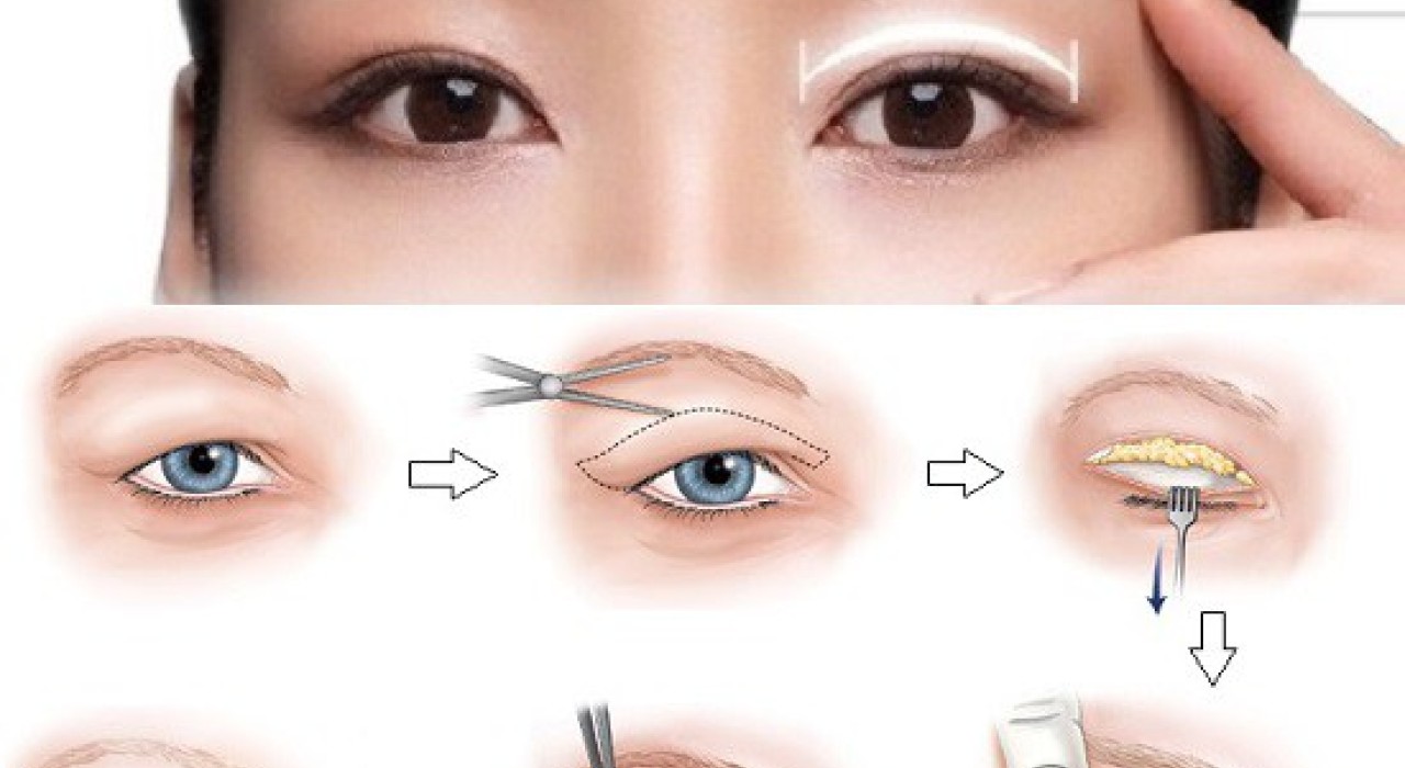PHẪU THUẬT KHÂU TẠO HÌNH MẮT HAI MÍ