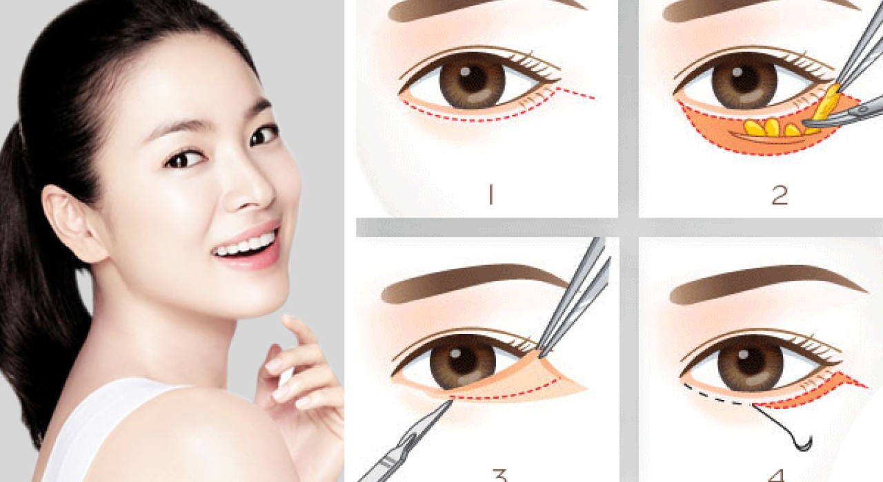 PHẪU THUẬT LẤY BỌNG MỠ MI DƯỚI