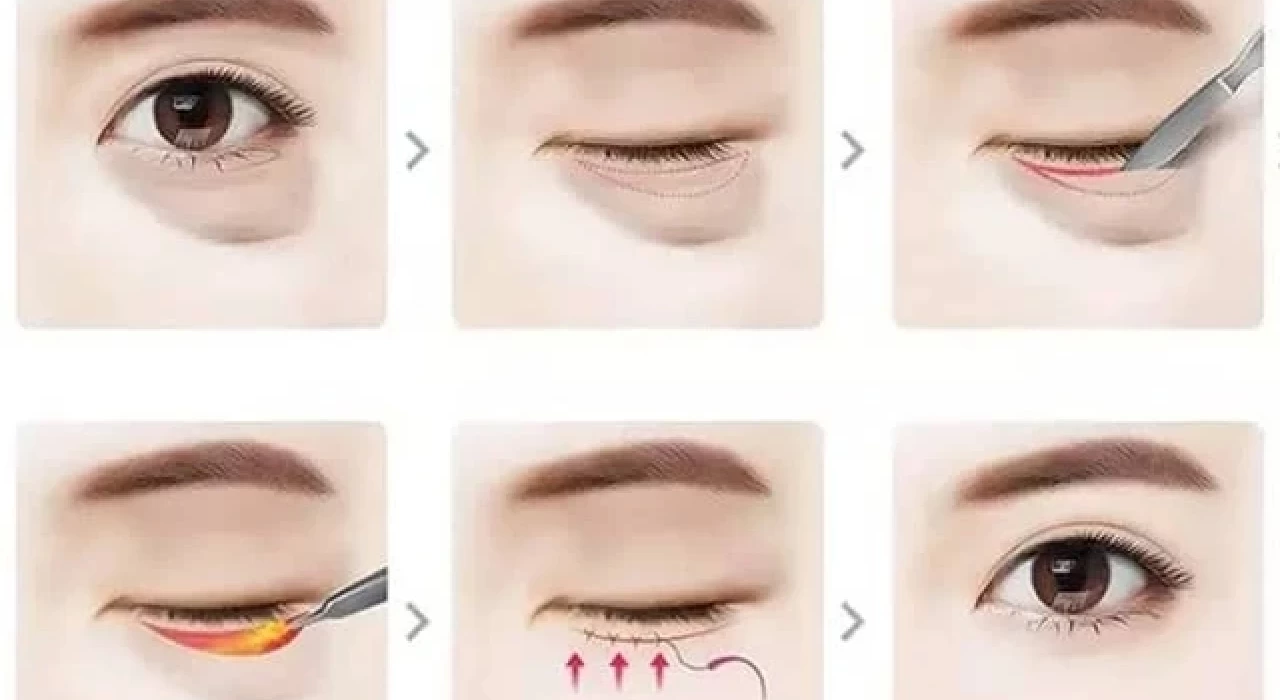 PHẪU THUẬT THỪA DA MI DƯỚI