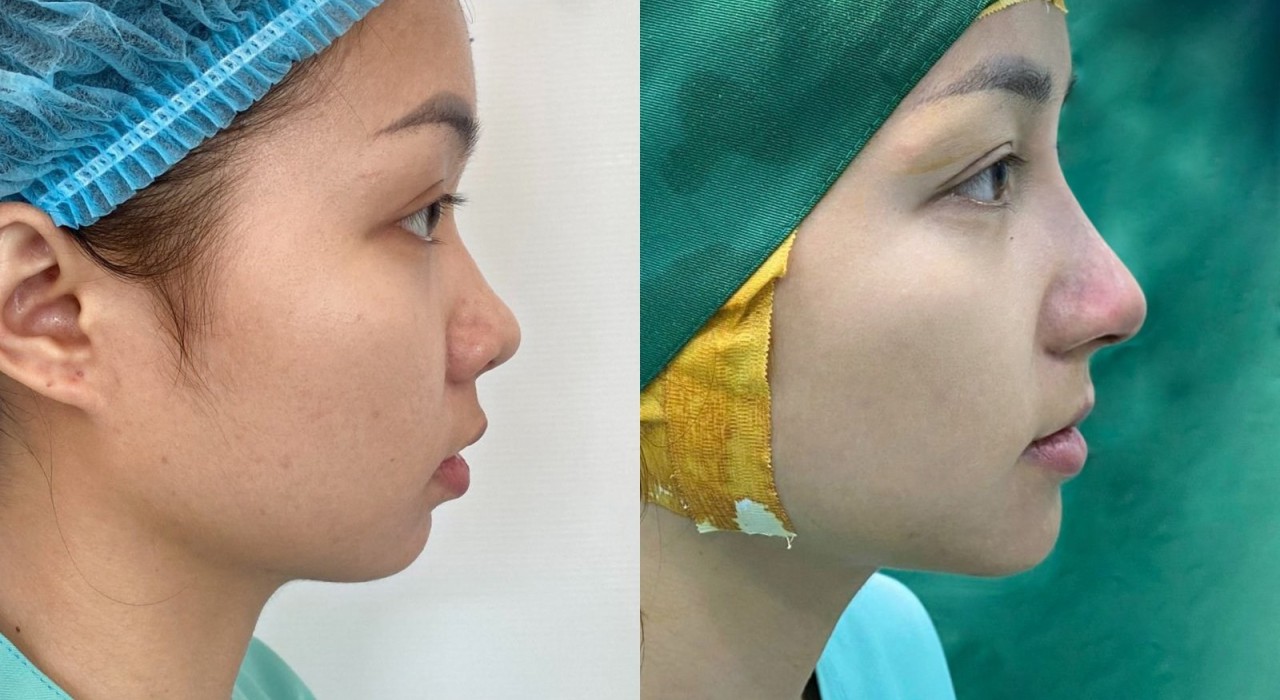 PHẪU THUẬT NÂNG MŨI BẰNG VẬT LIỆU ĐỘN NHÂN TẠO KẾT HỢP SỤN TỰ THÂN (sụn vành tai)