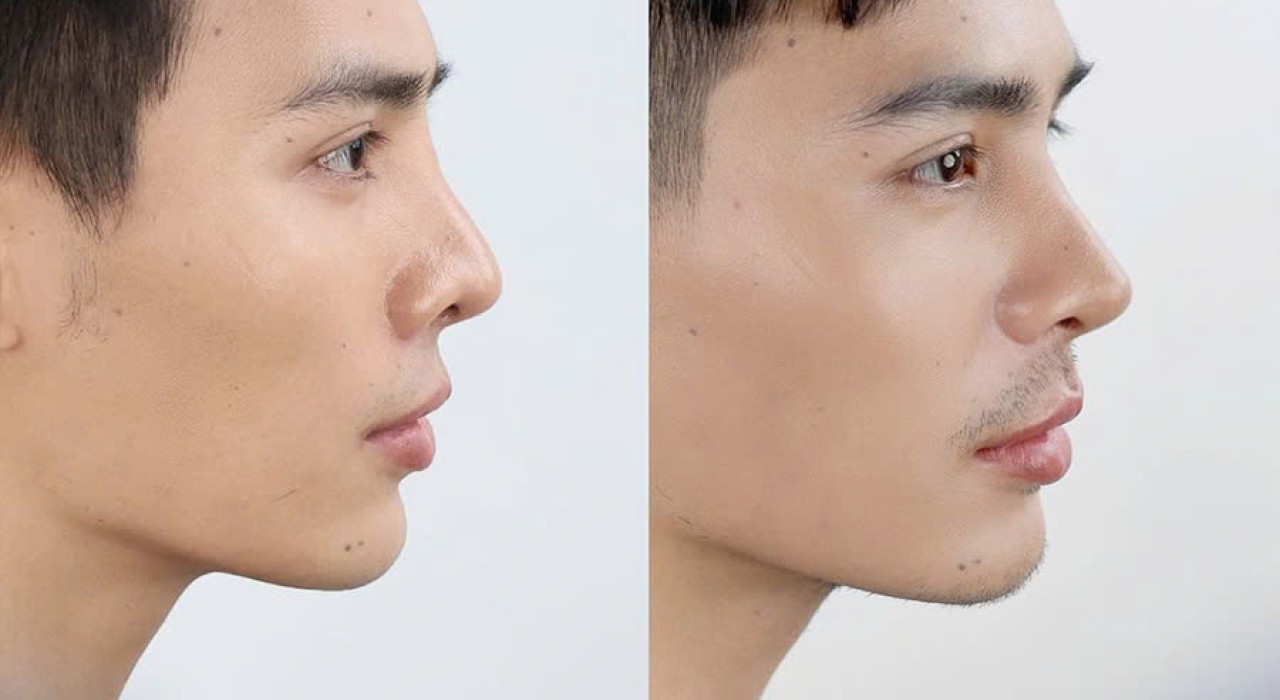 PHẪU THUẬT NÂNG MŨI BẰNG VẬT LIỆU ĐỘN NHÂN TẠO